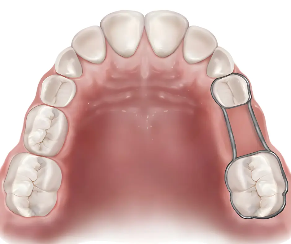 Fixed space maintainer for kids dental care